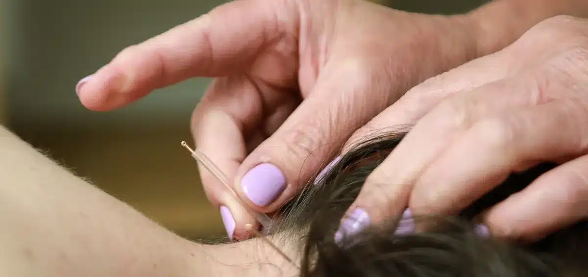 Person having acupuncture as a hay fever treatment